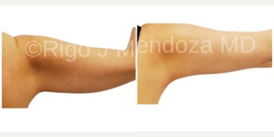 25-34 year old woman treated with Liposuction, Renuvion, Arm Lift - This patient wanted tightening of her arms without having to undergo a brachioplasty. Very happy with her lipo and Renuvion J Plasma results.
