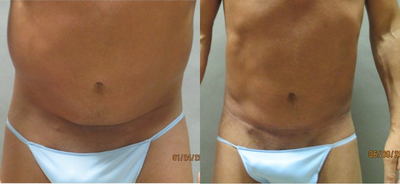 35-44 year old man treated with Tummy Tuck - This patient had removal of excess abdominal skin.