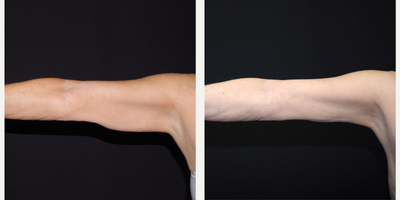 55-64 year old woman treated with Smart Lipo - 64 year old female received Smart Lipo to the arms; photos depict the patient's results 3 months post-op.