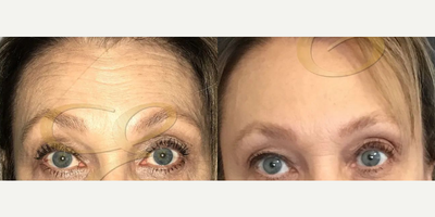Woman treated with Dysport - Woman treated with Dysport
