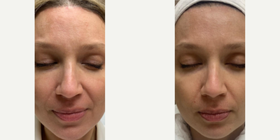 Woman treated with PRP Injections - Woman treated with PRP Injections