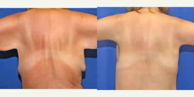 25-34 year old woman treated with Back Lift - This female patient was unhappy with the excess skin and fat on her back. Dr. Katzen was able to remove excess skin and fat off her back by performing an upper body lift (also known as a torsoplasty). She loves her results.