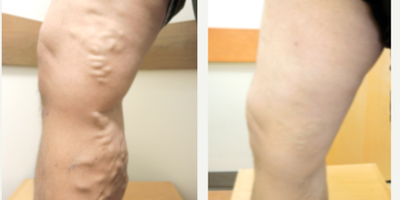 45-54 year old man treated with VenaSeal - Treatment for chronic venous insufficiency