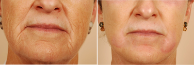 Deep Peel - Phenol-Croton Oil - 
	These are the results from a phenol-croton oil peel. This is the deepest peel with social downtime of 7-14 days, but will be the most effective for treating stubborn deep lines around the eyes and mouth, due to either genetics, sun or smoking.

