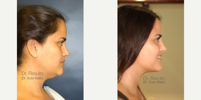 35-44 year old woman treated with Chin Liposuction - Only 11 days after my trademarked procedure 'The Angle. This a refined submental (or chin) liposuction.