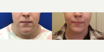 Patient treated with Genioplasty - Chin Reduction and Contour - 25 to 34 year-old female patient is 1 year post-op from Facial Feminization surgery. Her procedures included: Placement of Tissue Expander, Septorhinoplasty (closed) with Cartilage Grafts, Cheek Implants (small), Chin Reduction and Contour, Soft Tissue to Nasolabial Folds, Subnasal Lip Lift with Fat Augmentation to Lips, Thyroid Cartilage Shave and Voice Feminization, Voluma 2cc, Submental Liposuction, and Hairline Lowering, Hairline Forehead Lift and Orbital Bony Contour.