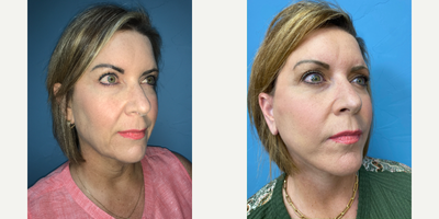 45-54 year old woman treated with Neck Lift - Patient had a Facelift and Neck lift with suction assisted Lipo