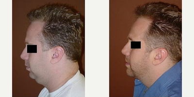 Man treated with Chin Liposuction - Man treated with Chin Liposuction