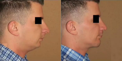 Man treated with Chin Liposuction - Man treated with Chin Liposuction