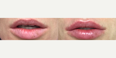 Woman treated with Hyaluronidase - Woman treated with Hyaluronidase for improperly injected lips leaving it asymmetric. Volume was also replenished using fillers to correct shape and balance.
