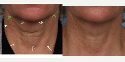 55-64 year old woman treated with Micro Botox - Before:   56 year old female post liquid facelift now wants to address skin laxity and lines in her neck to balance out her amazing filler results without surgery. After:  Two weeks after MicroTox injections to area inside white arrows 70 units and 30 units per side along jaw line green arrows demonstrate where Botox was injected to lift her jowls also known as a Nefertiti Botox lift.  Note dramatic results shrink wrap effect on neck skin creating tightening and line reduction.  This can only be accomplished with MicroTox.  Patients with platysmal bands can have combined techniques to address both bands and skin tightening with Botox injected at different depths.