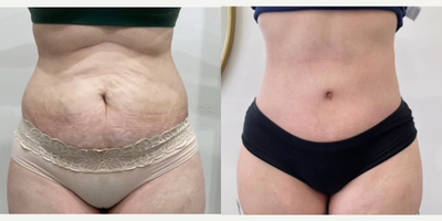 25-34 year old woman treated with Drainless Tummy Tuck - Drainless Abdominoplasty