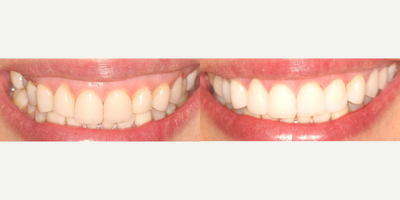 Woman treated with Teeth Whitening, Smile Makeover - To treat gummy smile there are different techniques so the selection of the correct treatment depends on the cause of the gummy smile. In this case, we did coronal lengthening, with subsequent placement of dental laminates.