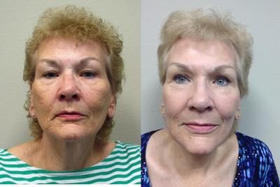 65-74 year old woman treated with Age Spots Treatment - 71 yo who underwent J-Plasma facial resurfacing