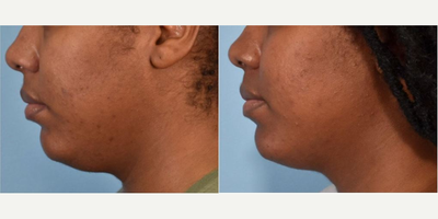 Woman treated with CoolSculpting - Woman treated with CoolSculpting.