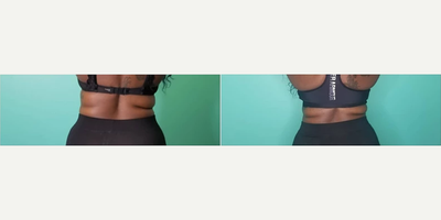Woman treated with i-Lipo - This client lost 3.5 inches and 15 lbs in 6 weeks with weekly i-Lipo and Bee Fit Injections
