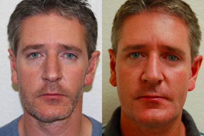 35-44 year old man treated with Fat Transfer - Fat grafting to treat facial asymmetry. His left face was had soft tissue loss due to a rare condition called Perry Romberg Syndrome. He was treated by harvesting 50cc of fat from his abdomen and flanks and transferred to his left face, jaw line, chin, and cheek area.