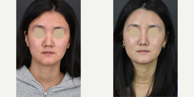 18-24 year old woman treated with Asian Rhinoplasty, Rhinoplasty - This patient came to us seeking to narrow her alar base and achieve a more delicate and defined nose shape while maintaining a natural appearance. Patient's rib cartilage was used in the surgery.
