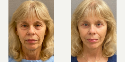 66 year old woman treated with Deep Plane Facelift, Facelift, Neck Lift, Eyelid Surgery - 66 year old woman treated with Deep Plane Facelift, SMAS Facelift, Facelift, Neck Lift, Eyelid Surgery through blepharoplasty with skin pinch performed under local anesthesia with sedation