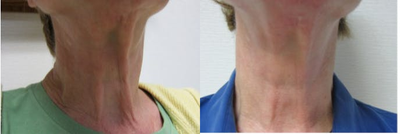65-74 year old woman treated with Fractora RF - 65-74 year old woman treated with 3 Fractora RF treatments
