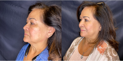 65-74 year old woman treated with Skin Tightening - Evoke Cheeks before and 6 weeks after. Evoke Face is the industrys first hands-free applicator designed specifically to address cheeks and jowls. The patented technology harnesses the power of RF energy to remodel facial tissue and improve its appearance. Zero downtime. Zero pain. All the results.