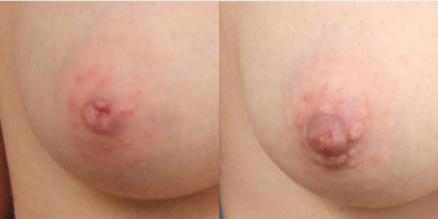20 year old woman treated with Inverted Nipple Surgery - This is a 20 year old that felt like there was a hole in her nipple and very unhappy with her appearance of inverted nipples, which affects up to 10 percent of the population to some degree. She wore a 36B bra and was happy with her breast size and not interested in breast augmentation. She underwent an office-based less than 30 minute correction of her inverted nipples with minimal incision approach. Her one year after photos are shown.