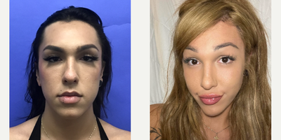 Patient treated with Cheek Augmentation - Cheek Implants (small) - 18 to 24 year-old female patient is 1 year post-op from Facial Feminization surgery. Her procedures included: Forehead Lift, Hairline Lowering, Orbital Bony Contouring, Septorhinoplasty (open) with Cartilage Grafts and Radix Graft, Cheek Implants (small), Chin Implant (custom carved central) with Reduction and Contour, Soft Tissue to Nasolabial Folds and Pyriform, Intranasal Lip Lift with Fat Augmentation to Upper Lip, Thyroid Cartilage Shave and Voice Feminization, Submental Liposuction, 300 Micrografts, and 1cc Voluma to Medial Cheeks.