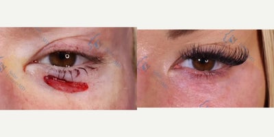 35-44 year old woman treated with Mohs Surgery - Pt had BCC under her L eye and was very concerned about the surgery affecting her vision and facial features. I performed a skin graft that healed beautifully and now the surgical site is unnoticeable.
