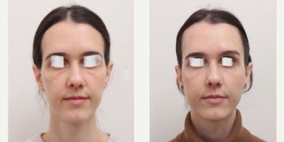 35-44 year old woman treated with Nonsurgical Facelift - Non-surgical face lift by autologus fat transfer. Significant volume loss and skin sagging was partly compensated by fat transfer. Performed area: forehead, temples, apple & side cheeks, nasolabial folds, under eye area