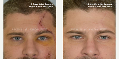 25-34 year old man treated with Facial Reconstructive Surgery, Scar Optimization Therapy - 25-34 year old man treated with scar optimization therapy.  Patient suffered a terrible car accident which left a large prominent scar on his left forehead and scalp.  He underwent meticulous laceration repair followed by scar optimization treatments afterwards.  He had multiple rounds of radiofrequency microneedling as well as intense pulsed light treatments for approximately 12 months.