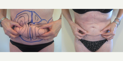 Laser Liposuction - Abdomen - Abdomen