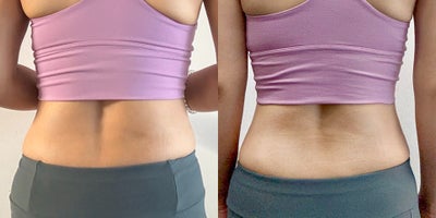 35-44 year old woman treated with Lipodissolve, BodyTite - Fat-dissolving injections to contour the flanks