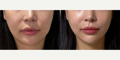 35-44 year old woman treated with Lipodissolve - Fat-dissolving injections to contour the facial line
