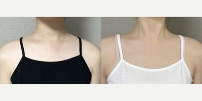 18-24 year old woman treated with Lipodissolve - Fat-dissolving injections to contour the shoulder line
