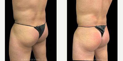 25-34 year old man treated with truFlex - Looking for a nonsurgical butt-lift? Check out TruSculpt Flex, a muscle sculpting device that mimics a workout in a 45 minute session. 1 Session 54,000 squats!