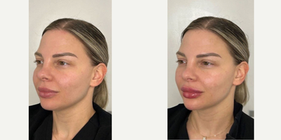 25-34 year old woman treated with Chin Filler, Lip Fillers, Dermal Fillers - Immediately after jawline, chin and lip filler by PA Steve