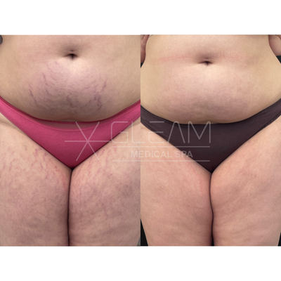 25-34 year old woman treated with Scar Removal, Opus Plasma - Stretch marks treated with Opus Plasma.