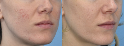 25-34 year old woman treated with Microneedling - One microneedling treatment combined with PRP.