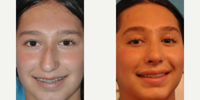 Woman treated with Rhinoplasty - Woman treated with Rhinoplasty involving the filing of a substantial dorsal hump, increased projection using a columellar strut, and centralization of the tip, correcting the crooked appearance of her nose.