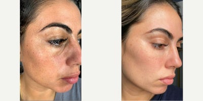 25-34 year old woman treated with Chemical Peel, Skin Lightening, PRP Injections, Microneedling - Skin Rejuvenation with Chemical Peel then Microneedling with PRP