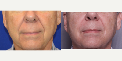 65-74 year old man treated with Sculptra - 65-74 year old man treated with Sculptra