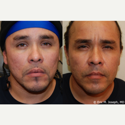Silikion-1000 Before & After: Acne Scarring Correction, 8 Years Later - Our handsome patient is seen 8 years following two acne-scar treatments with microdroplet Silikon-1000. This is an excellent example of the precision, permanence, and safety of medical-grade, liquid injectable silicone. It also demonstrates that Silikon-1000 does not migrate with time. Permanent acne scar correction with Silikon-1000 is especially useful for people with darker skin types, like our patient. People with darker skin types are not good candidates for resurfacing procedures like laser treatments, dermabrasion, or deep chemical peels, since darker skin types are more prone to problems like hyperpigmentation. Silikon-1000 treatments are painless with topical anesthetic and there is no downtime.