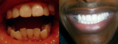 Porcelain Veneers  - Some patients want their teeth to look like everyone else's and some patients want their teeth to turn heads. &nbsp;Well, we will provide whichever option you prefer. &nbsp;This patient wanted a gleaming white smile that turns heads. &nbsp;It was is so white that we had difficulty capturing the blinding white color of the teeth without glare on our camera lens. &nbsp;This patient had several porcelain veneers placed by Dr.  Sarah Thompson.  This patient also received crowns and bridges and underwent a couple root canals and tooth extractions.  All of this was done in one appointment with use of sedation.  This patient had to return 2 weeks later for a follow-up post-opt check-up.&nbsp;
