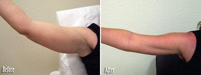 Mesotherapy to upper arms - Skinovative USA