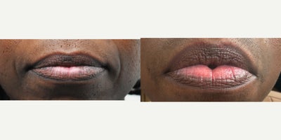 Laser lip spot removal before and after photos - Patient had discoloration on the lower lip from sun exposure and smoking.  This is before and after photos of one q-switched laser treatment to remove the discoloration.  Although not a cure, the results are fantastic using our Palomar Q-Yag V laser.