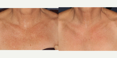 35-44 year old woman treated with Fraxel Repair - Fraxel Repair laser is used to treat signs of aging on a female patient's chest.
