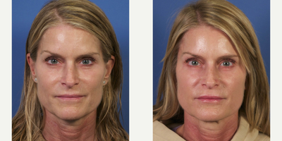Sculptra Facial Reshaping - Example of Sculptra injections to help rejuvenate this female's cheeks and pre jowl region as a non-surgical facelift procedure.