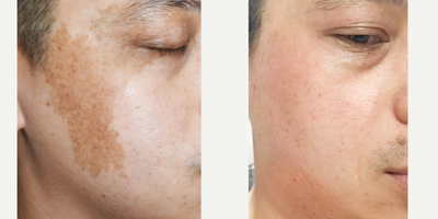 35-44 year old man treated with YAG Laser - Birthmark removal isn't about vanity.  It's hard to explain just how much angst is felt by patients with facial birthmarks. They get tired of the stares and the questions and just want to feel like everyone else does about their skin.