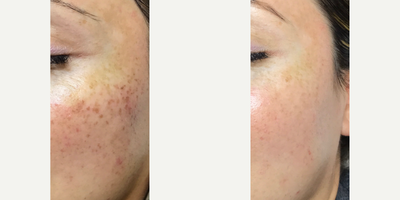 25-34 year old woman treated with Skin Rejuvenation, IPL, Neo Laser - Worked with the Amani Med Spa team to customize a program to help achieve patients' goals over time.