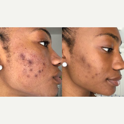 25-34 year old woman treated with Dermapen - 25-34 year old woman treated with Dermapen to address acne scarring